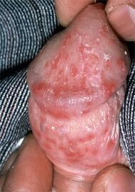 discharge from the penis caused by thrush